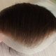 Illustration for article titled Hair Transplant in Rawalpindi/Islamabad